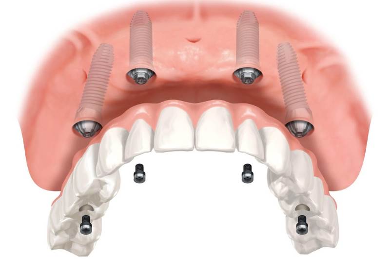 IMPLANTES OSEOINTEGRADOS